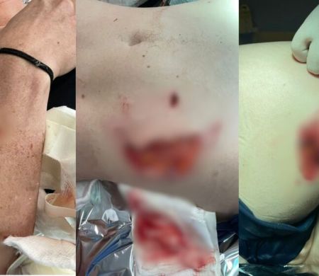 Capivara morde mulher e arranca partes do corpo dela em SC