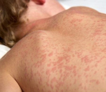 Busca ativa por casos de sarampo é intensificada no Estado 