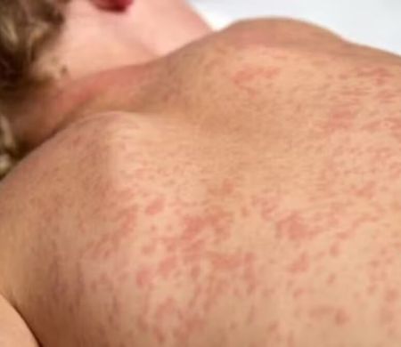 Avanço do sarampo em países vizinhos deixa MS em pânico